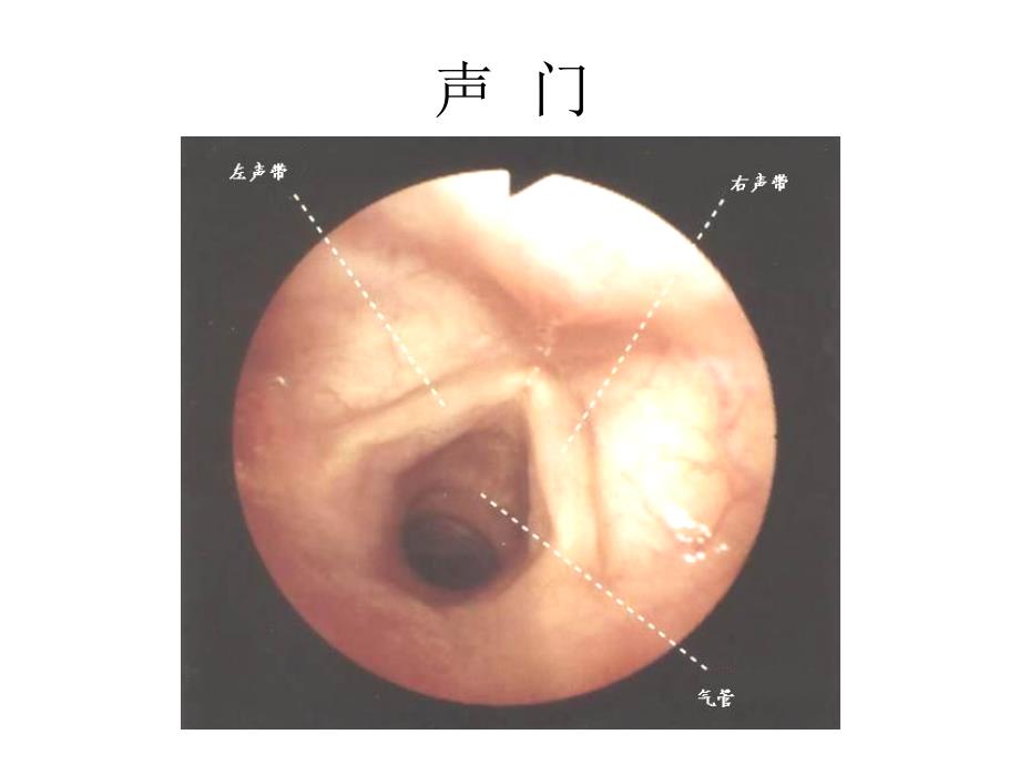 支气管镜精美图谱_第3页