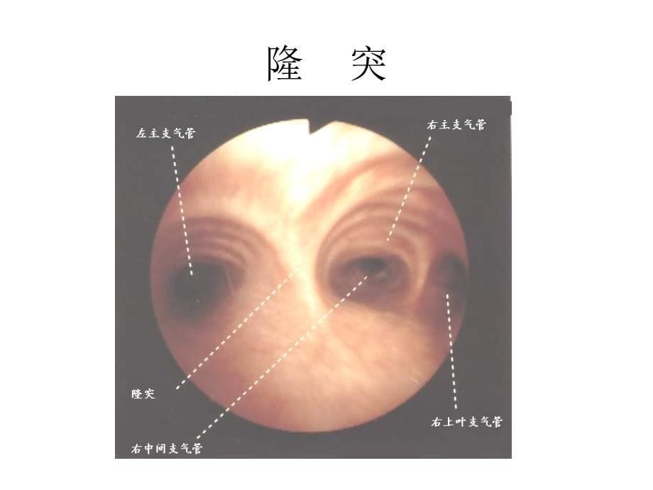 支气管镜精美图谱_第5页