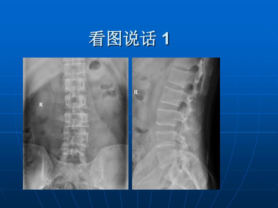 《椎体病随访》.ppt_第1页