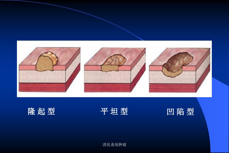 消化系统肿瘤课件_第3页