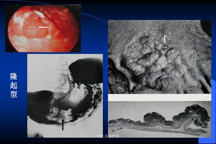 消化系统肿瘤课件_第4页