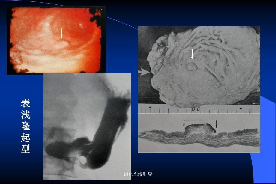 消化系统肿瘤课件_第5页