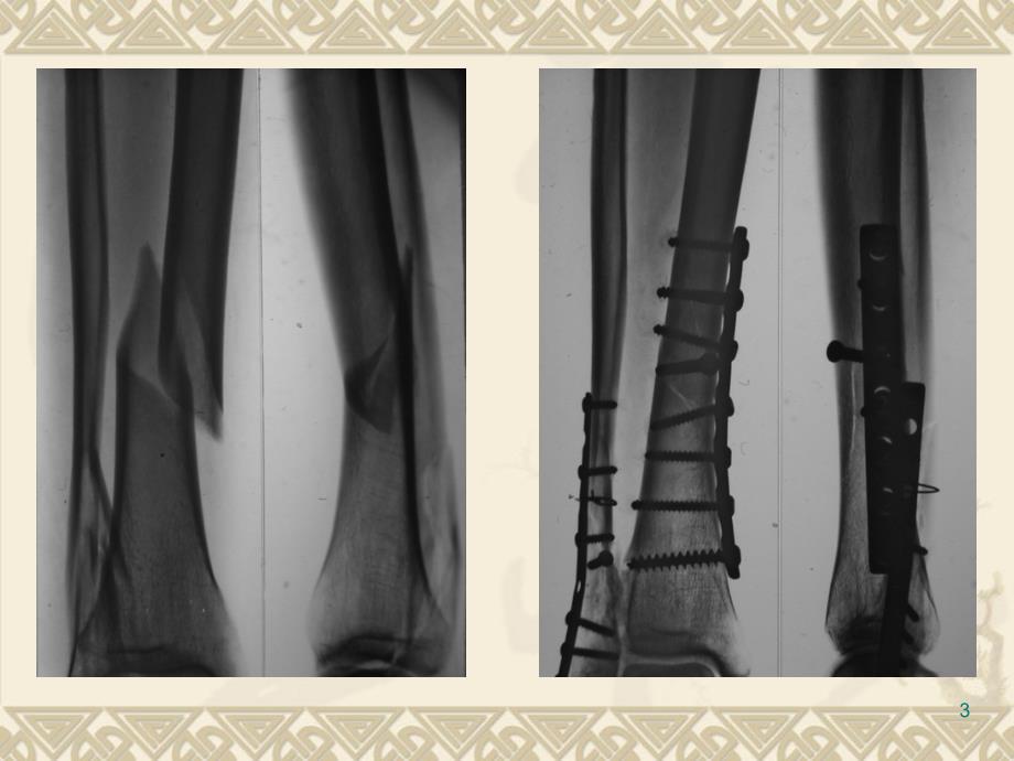 螺钉与钢板ppt课件_第3页