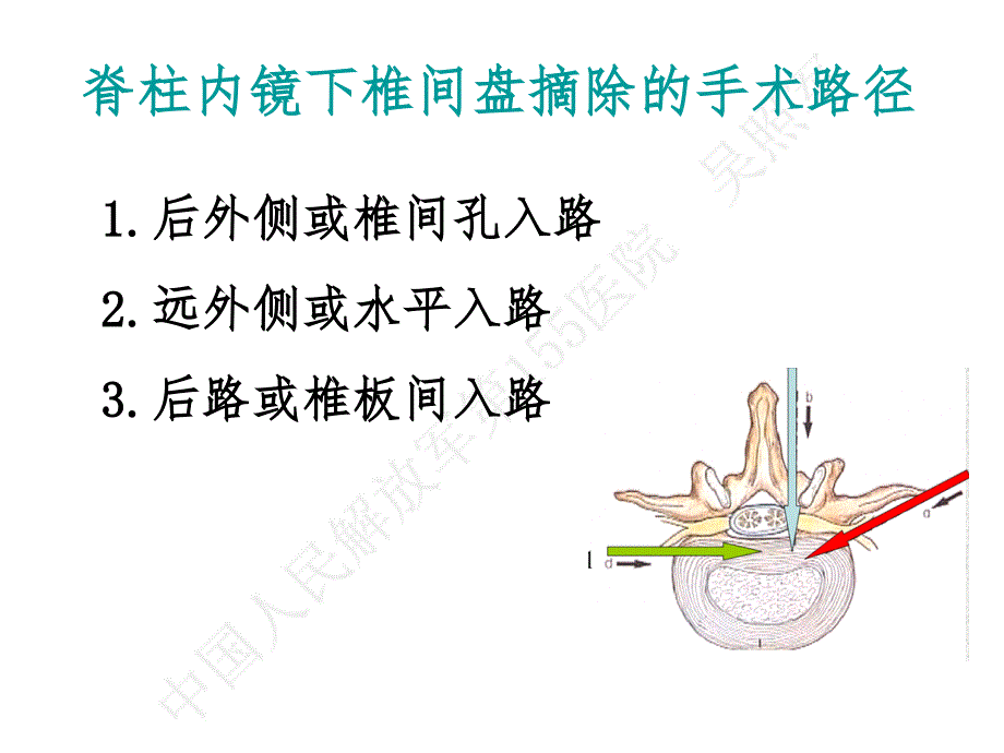 吴主任椎间孔镜ppt课件_第4页