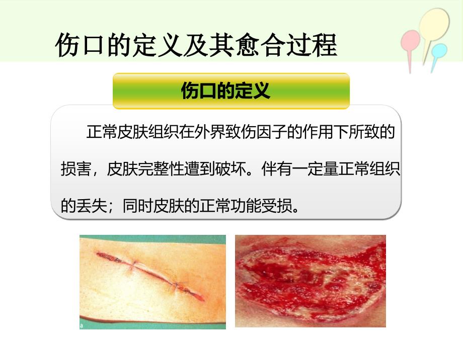 伤口造口新进展ppt课件文档资料_第3页