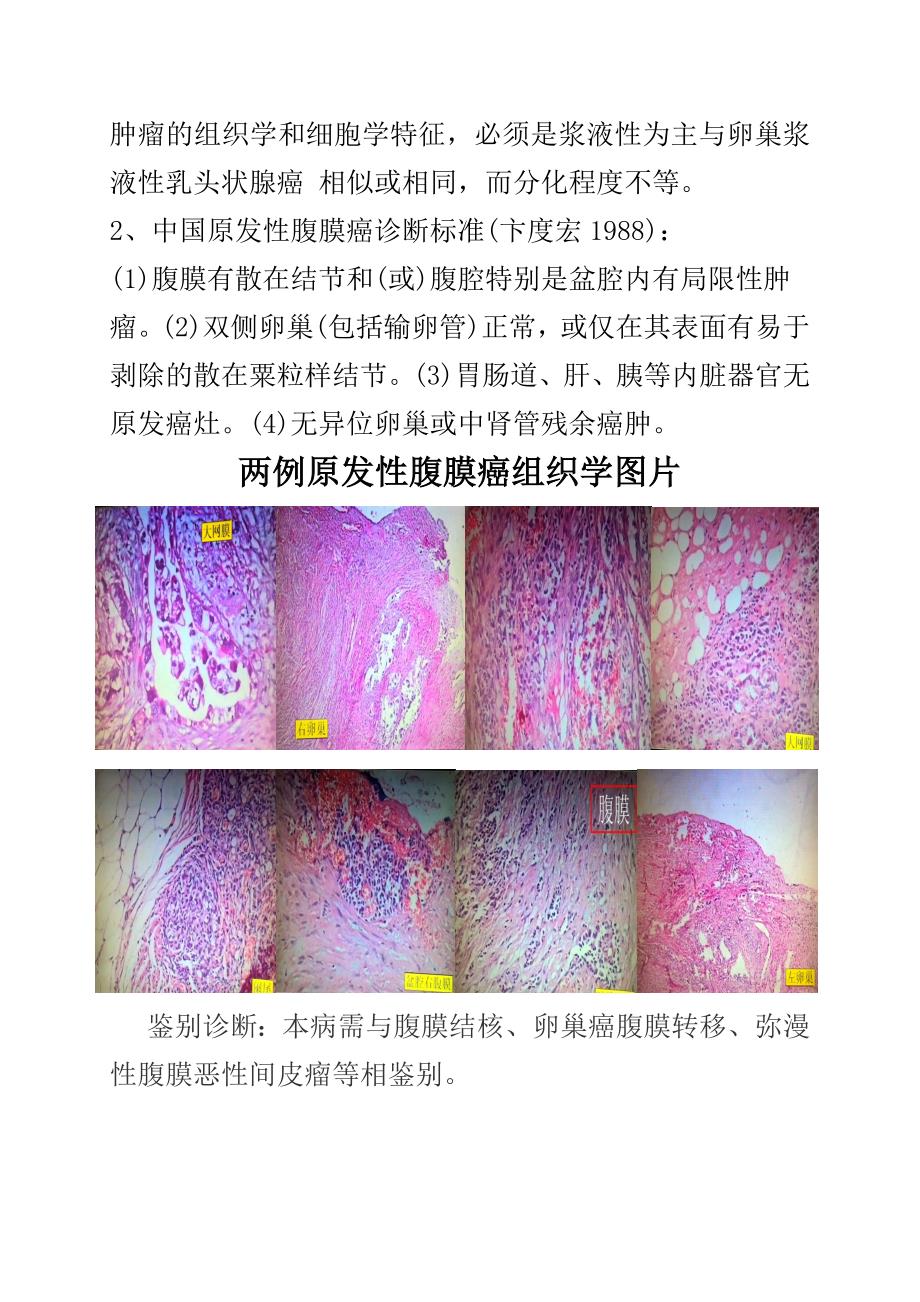 原发性腹膜癌的病理学诊断.doc_第3页