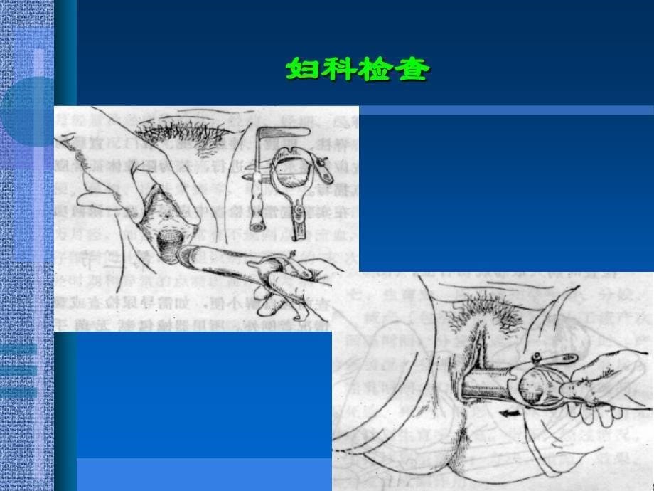 主刀医生常用的妇科检查及小手术_第5页