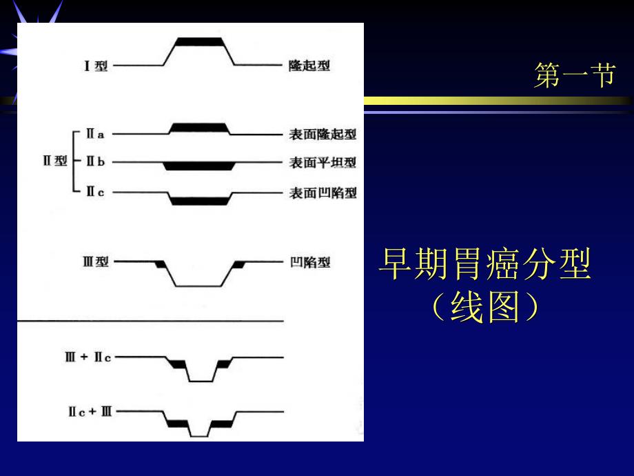 医学影像学：第十章 胃肿瘤_第2页