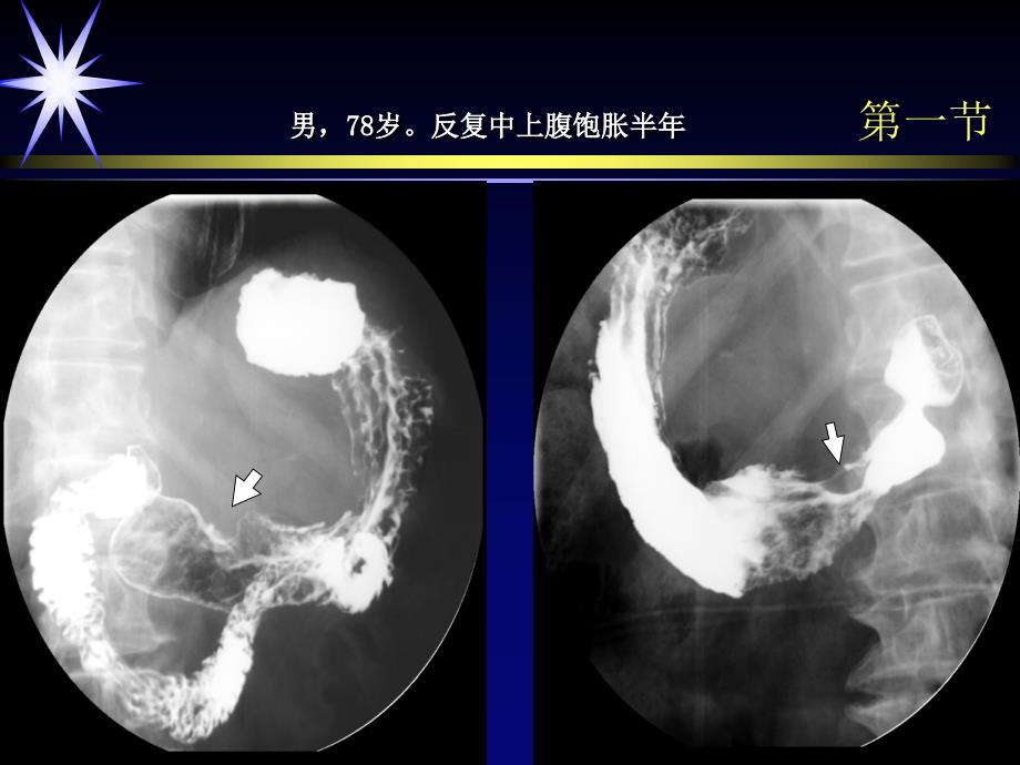 医学影像学：第十章 胃肿瘤_第4页