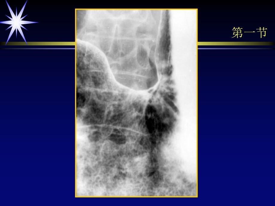 医学影像学：第十章 胃肿瘤_第5页