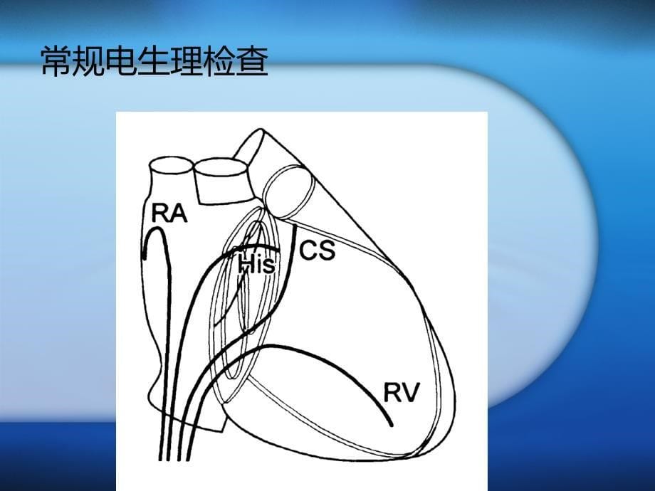 射频消融术及其护理_第5页