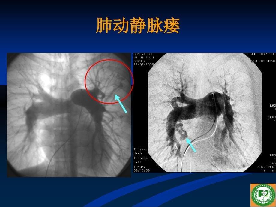 右心导管技术在肺动脉高压诊治中的价值_第5页