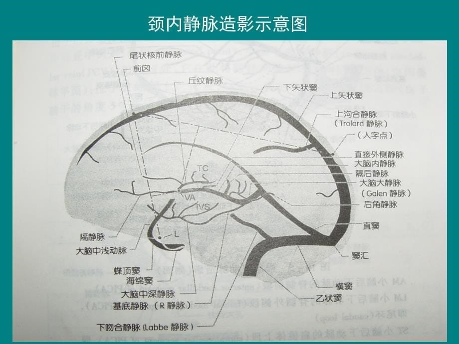 静脉窦血栓的影像诊断_第5页