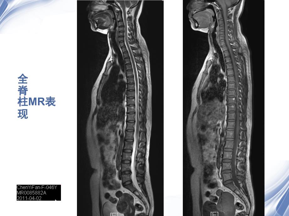 医学影像脊柱外伤影像现_第3页