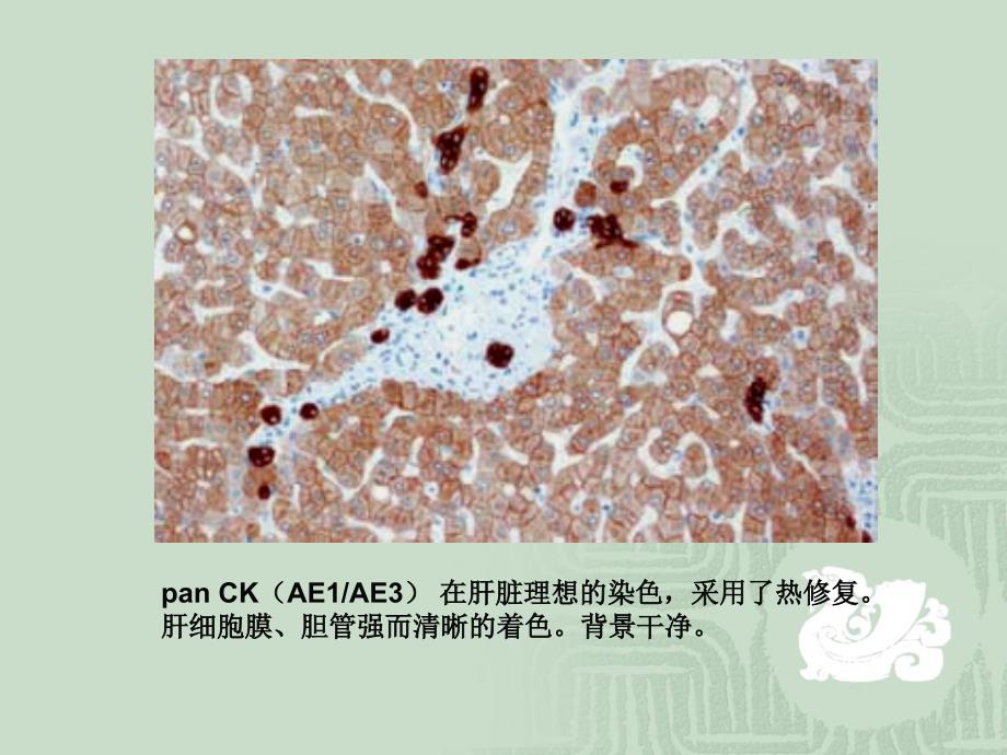 免疫组化结果判断及常见问题的分析_第4页