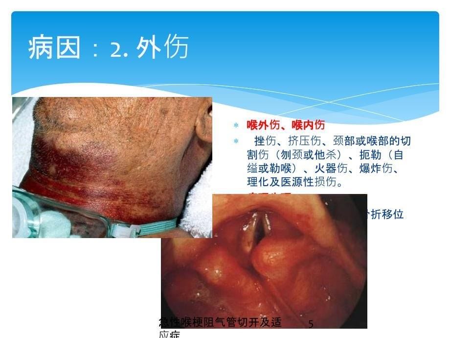 急性喉梗阻气管切开及适应症培训课件_第5页