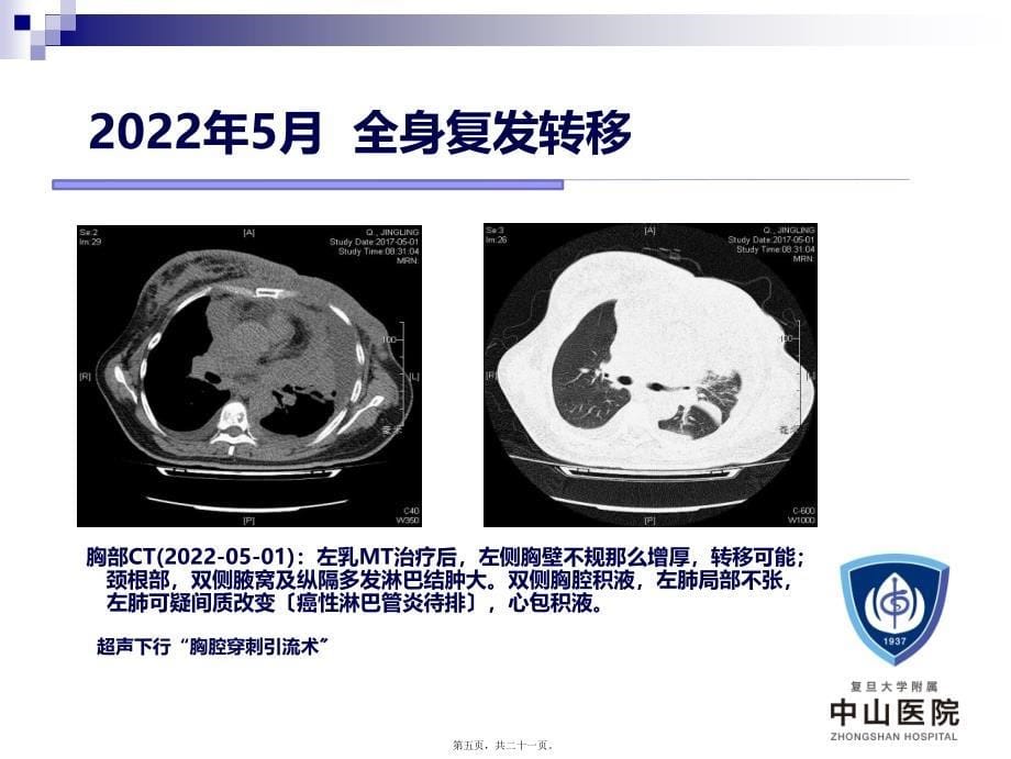 乳腺癌病例分享_第5页