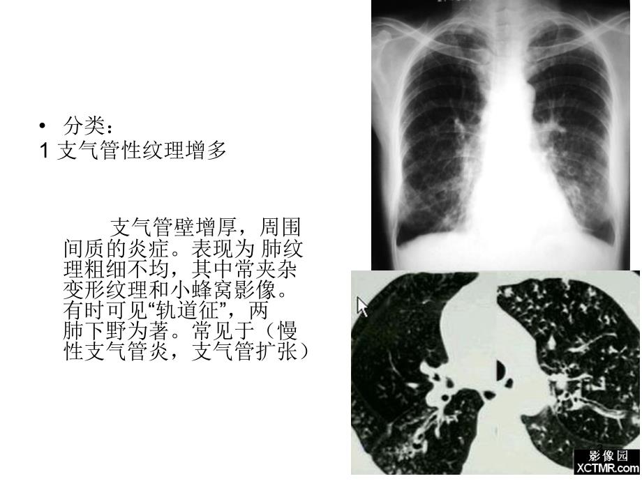 肺纹理增多邱振康_第3页