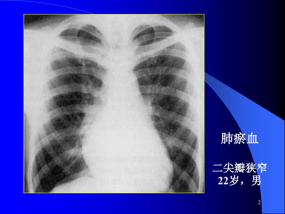 肺淤血的X线表现ppt参考课件_第2页