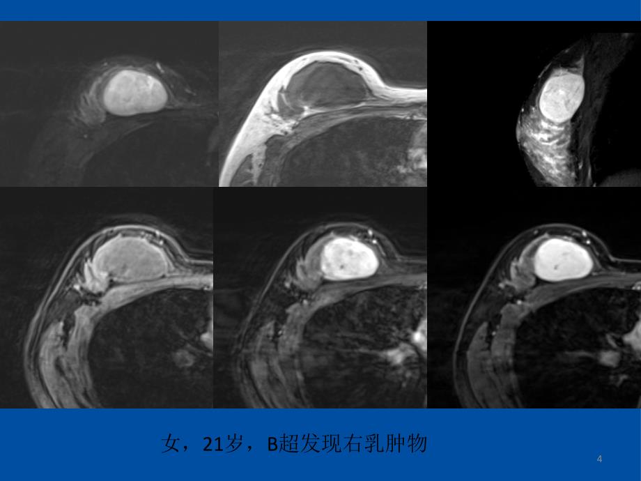 乳腺叶状肿瘤影像表现PPT参考幻灯片_第4页