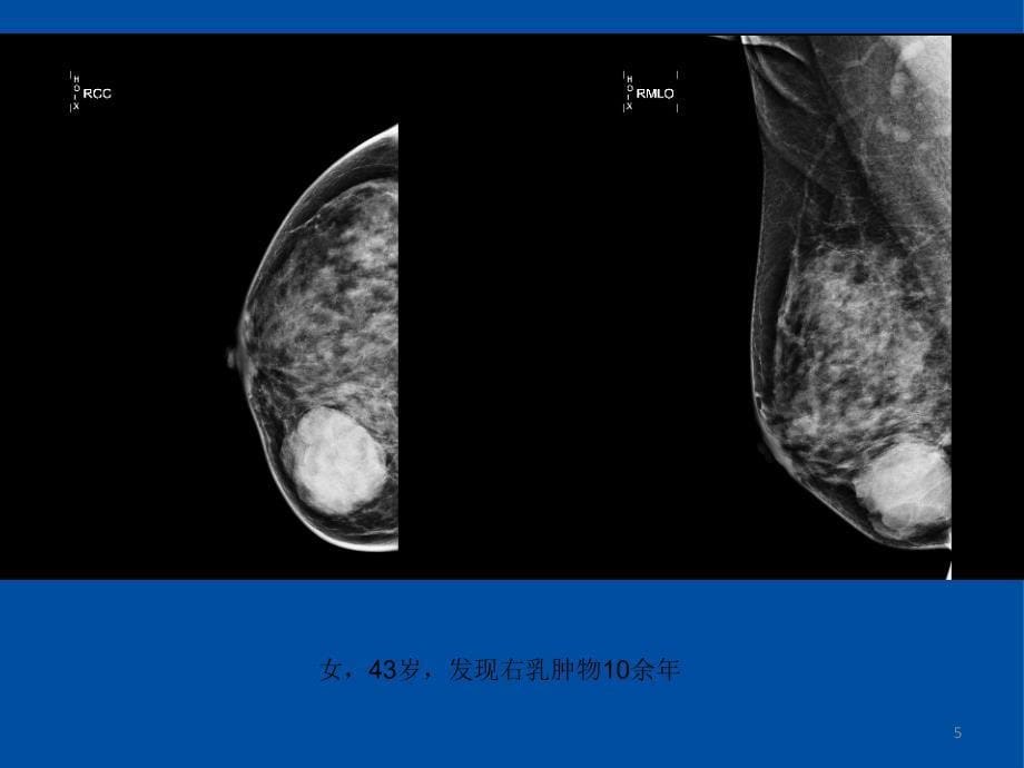 乳腺叶状肿瘤影像表现PPT参考幻灯片_第5页