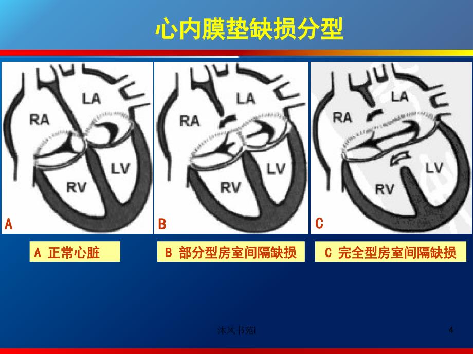 心内膜垫缺损[行业经验]_第4页