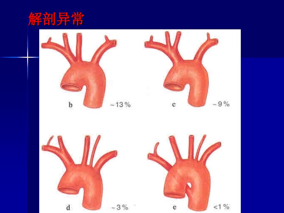 主动脉夹层及腹主动瘤CTA影像学课件_第4页