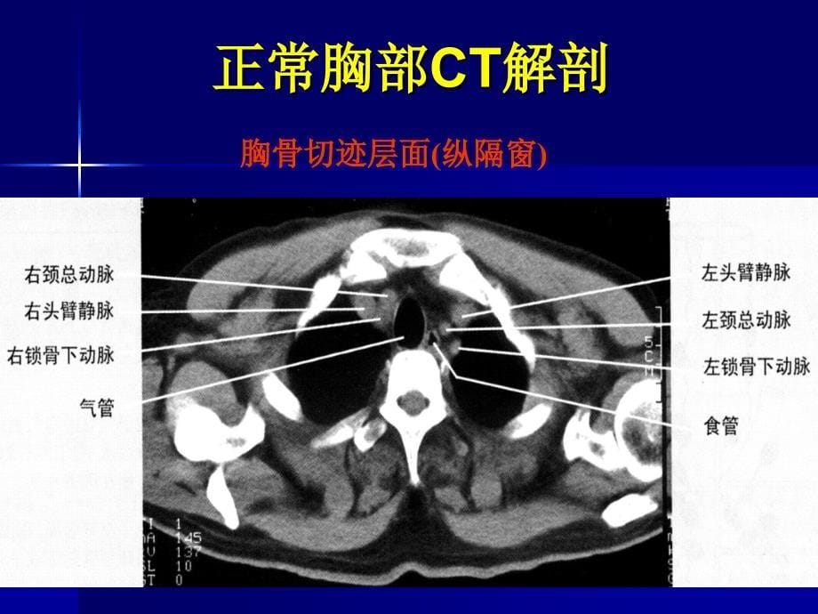 主动脉夹层及腹主动瘤CTA影像学课件_第5页