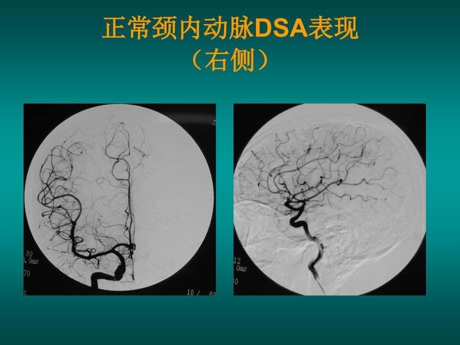 如何阅读神经系统DSA片.ppt_第5页