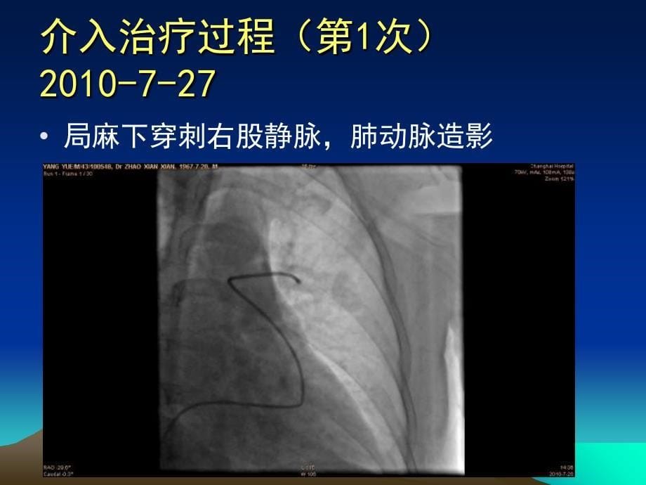 经房间隔穿刺途径行肺-动静脉瘘封堵术_第5页