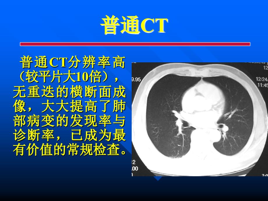 胸部各种影像学检查-常见病的CT诊断_第2页