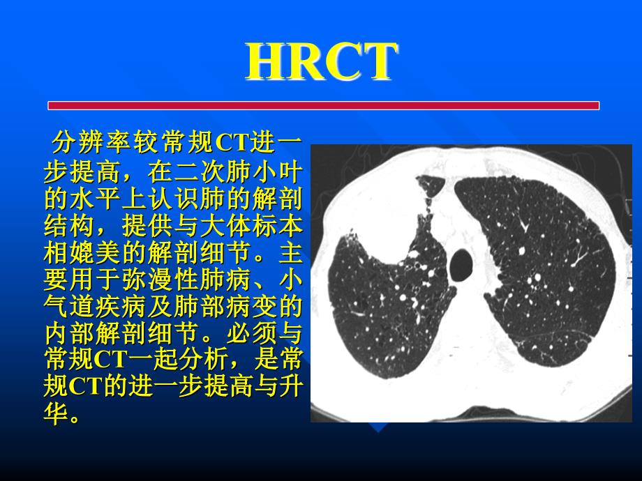 胸部各种影像学检查-常见病的CT诊断_第3页