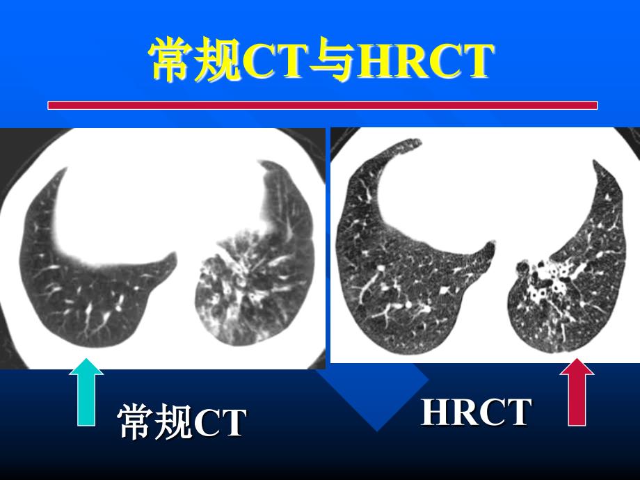 胸部各种影像学检查-常见病的CT诊断_第4页