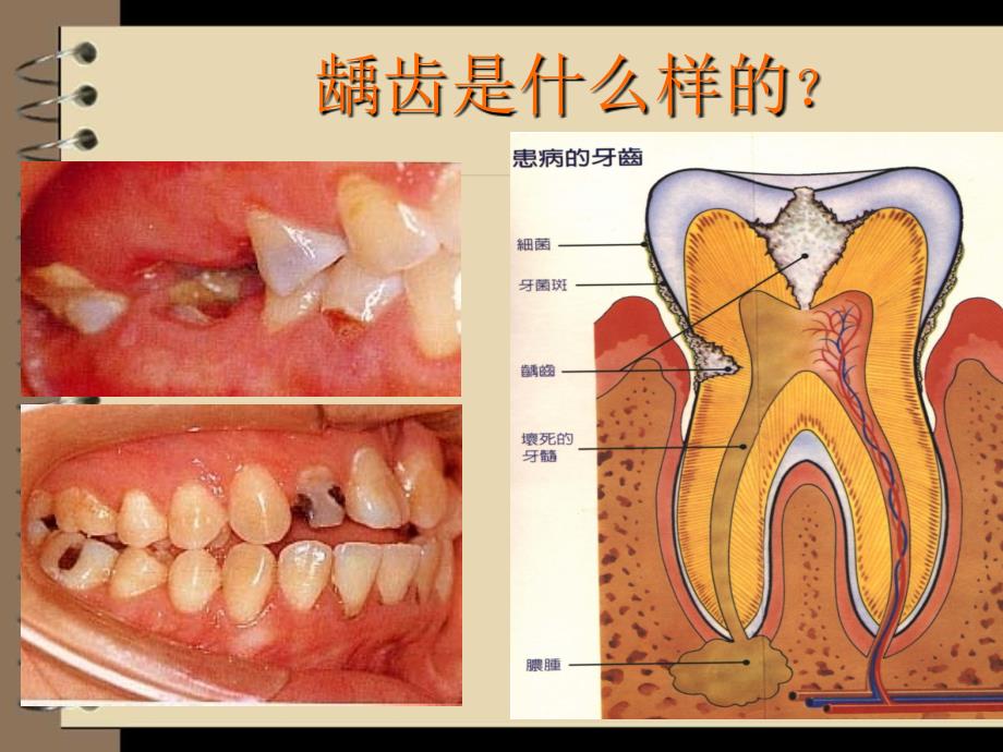 口组病第9章 龋病全面_第4页