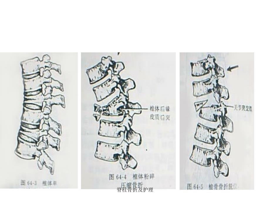 脊柱骨折及护理课件_第4页