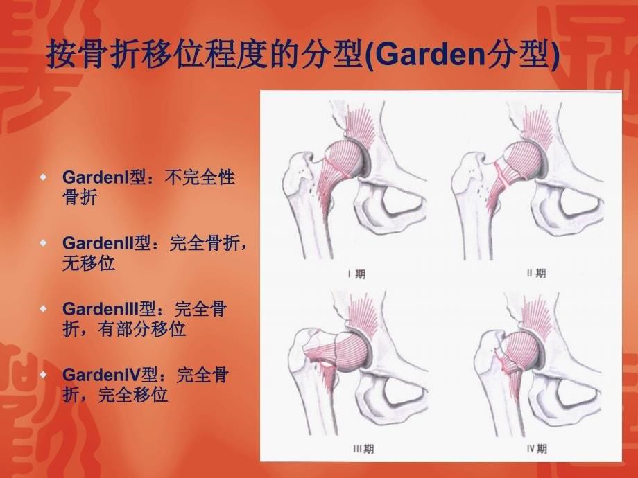 骨折常用分型_第5页