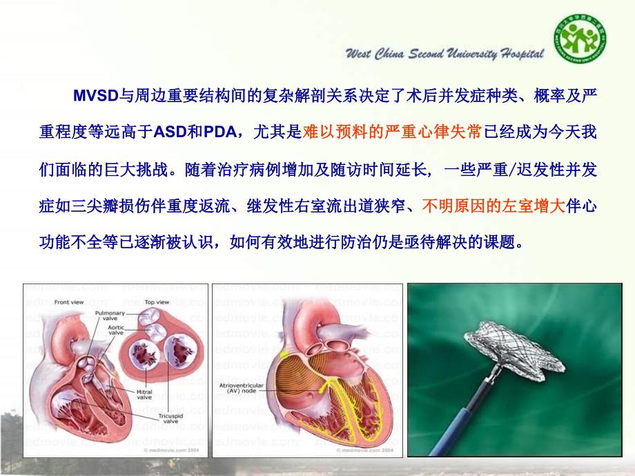 儿童室间隔缺损介入治疗的挑战教学课件_第2页