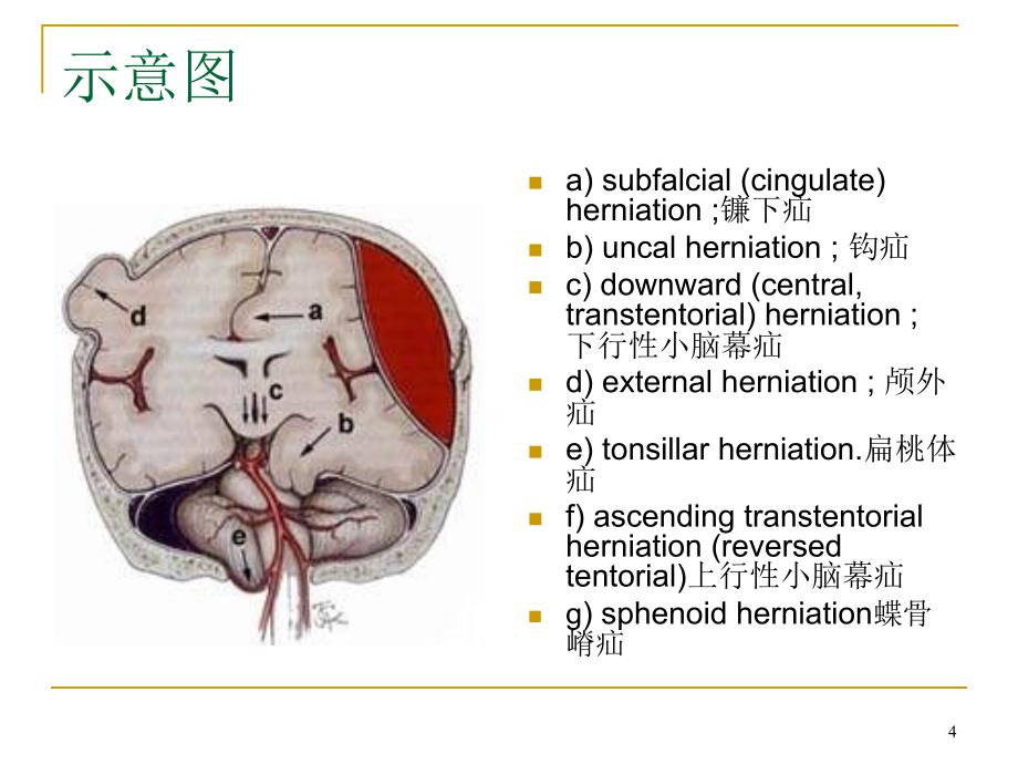 图解脑疝ppt课件_第4页