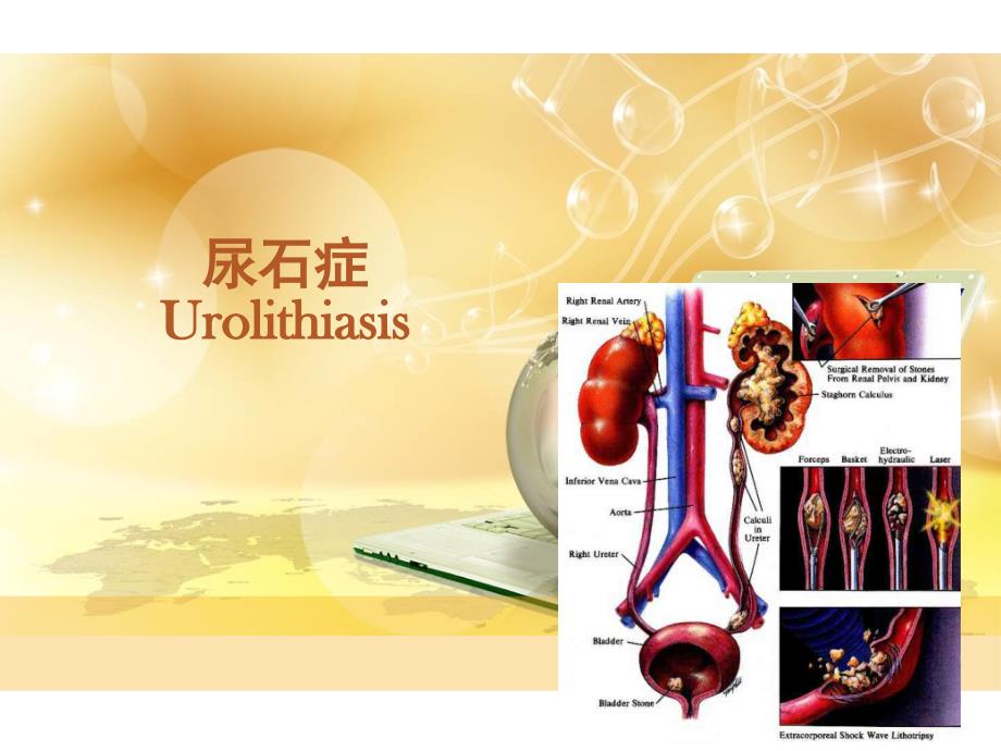 泌尿系结石课件_第1页