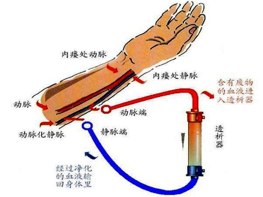 动静脉内瘘的护理与使用_第4页