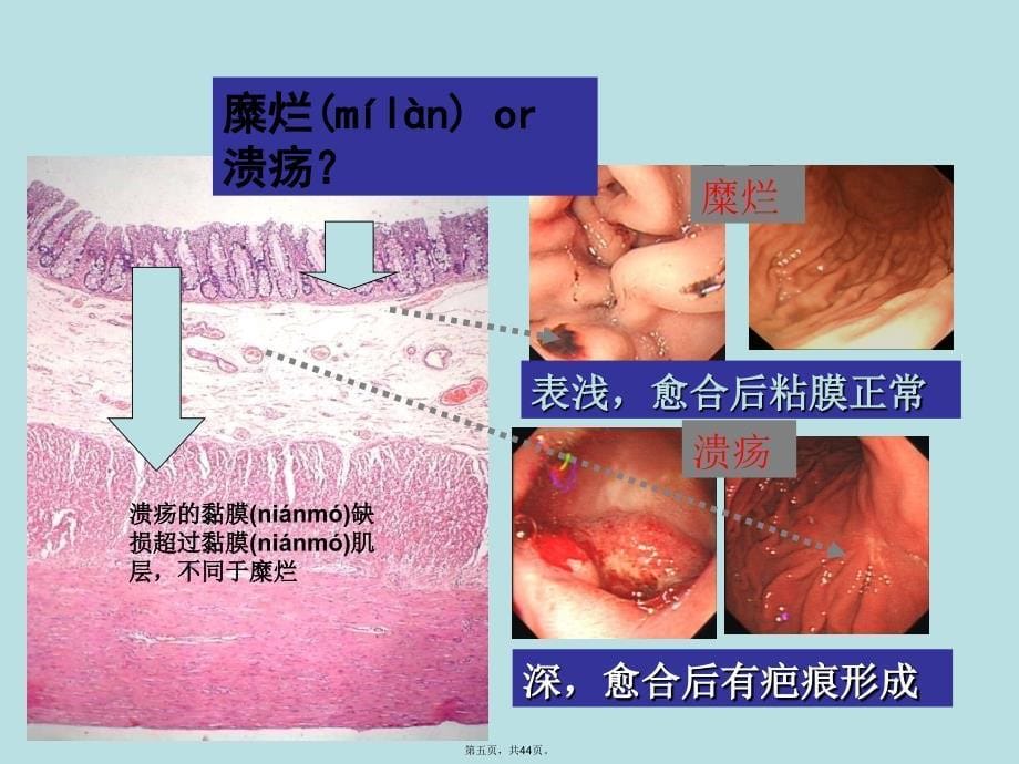 内科学——消化性溃疡电子教案_第5页