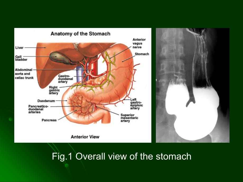 腹腔镜远端胃癌D2手术解剖ppt.ppt_第3页