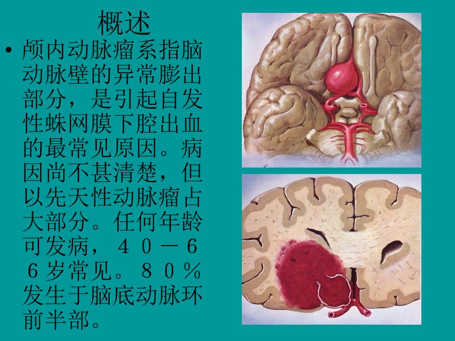 颅内动脉瘤介入治疗_第2页