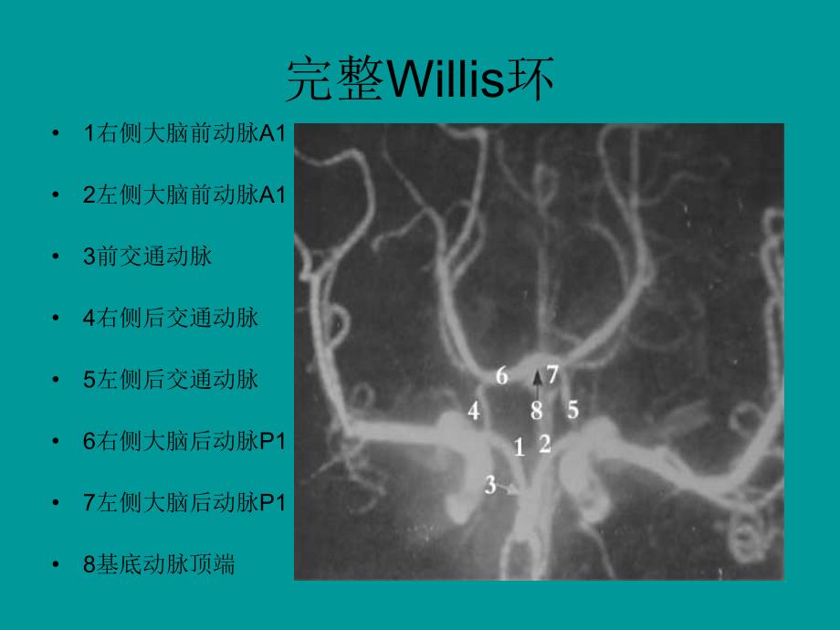 颅内动脉瘤介入治疗_第3页