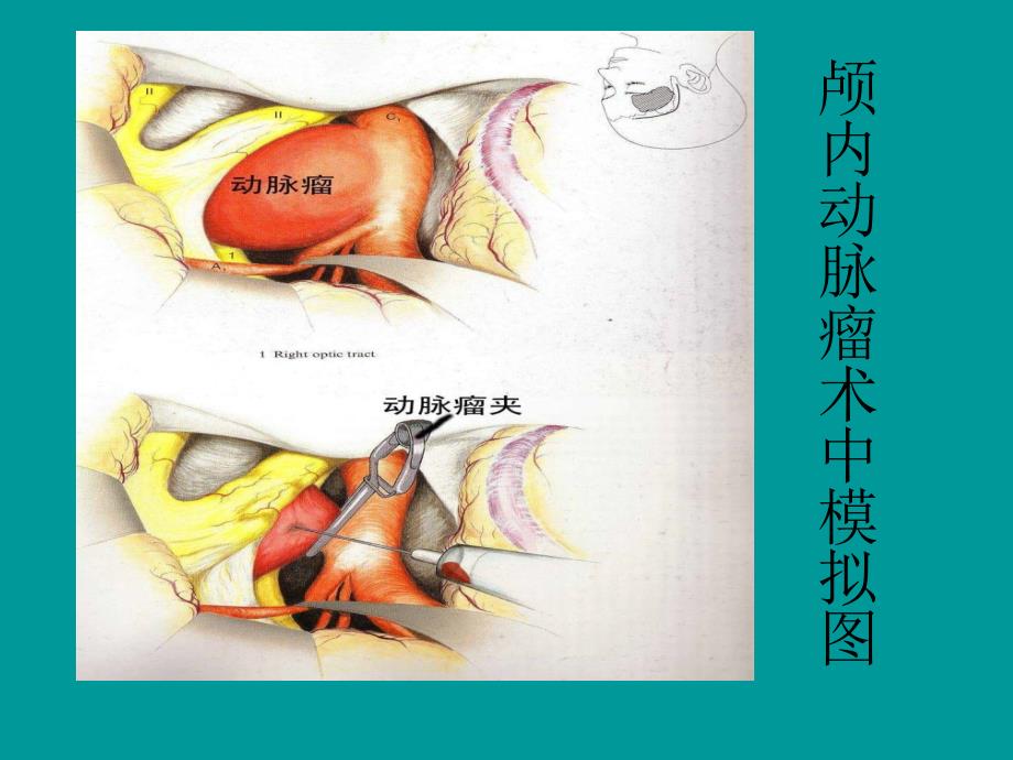 颅内动脉瘤介入治疗_第4页