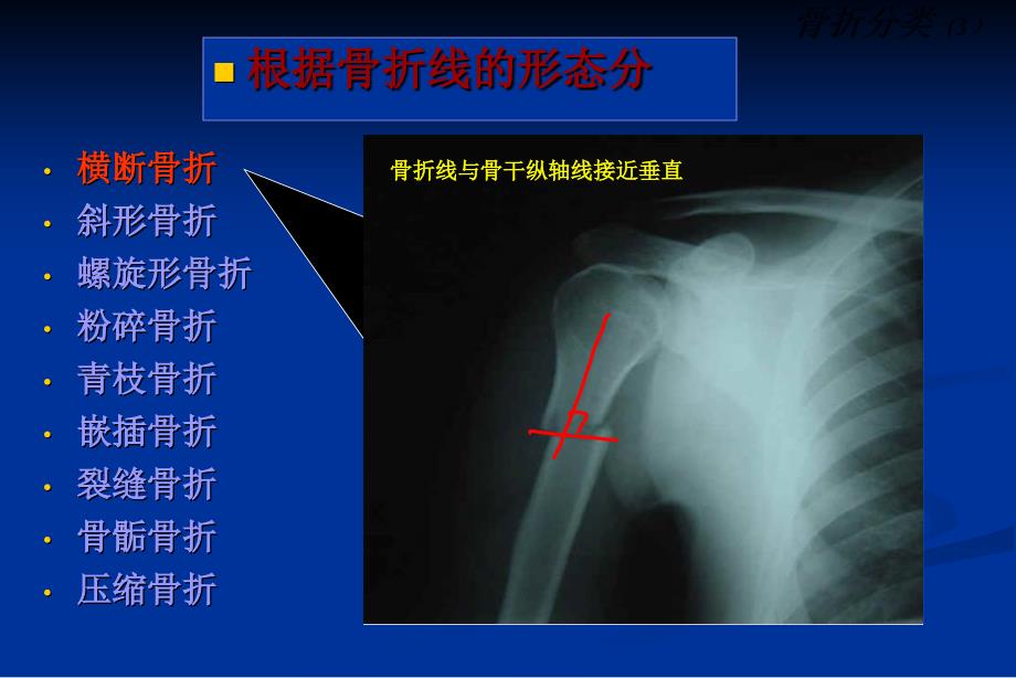 上肢骨折传统治疗技巧讲座_第3页