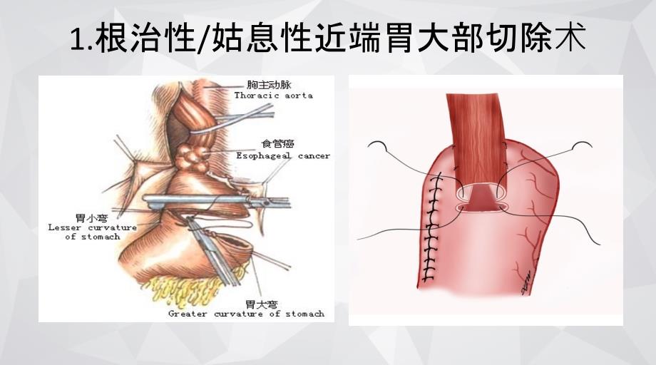 胃癌术后吻合口瘘诊治_第4页