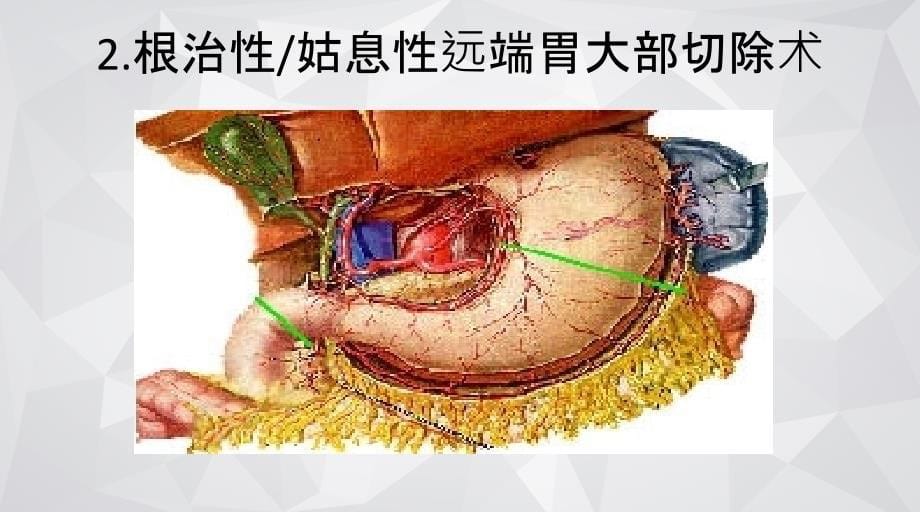 胃癌术后吻合口瘘诊治_第5页