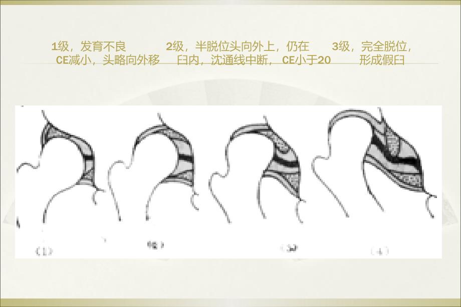 发育性髋关节异常影像学表现课件_第4页