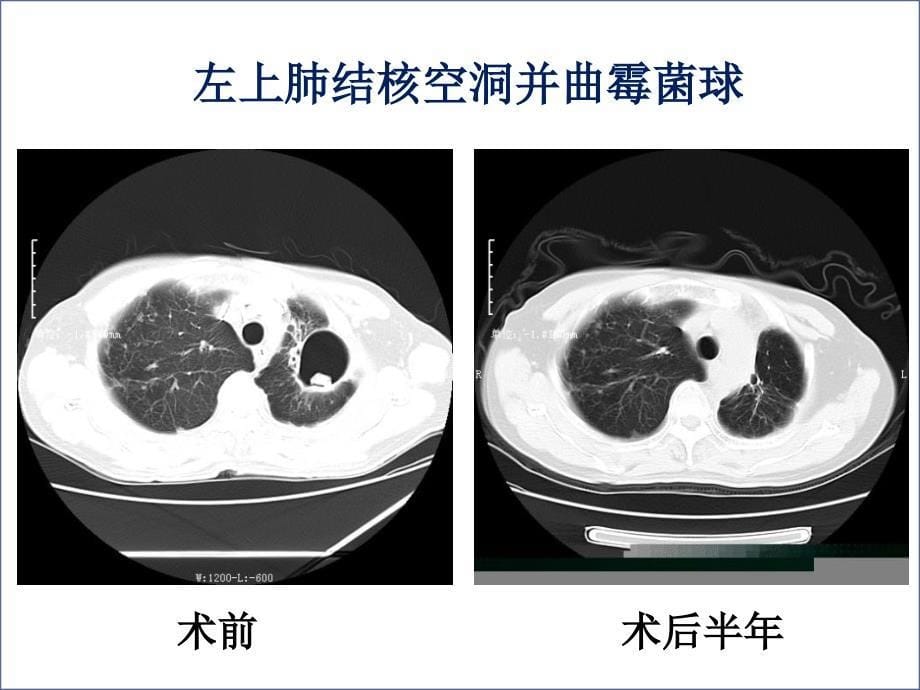 结核病的外科治疗_第5页